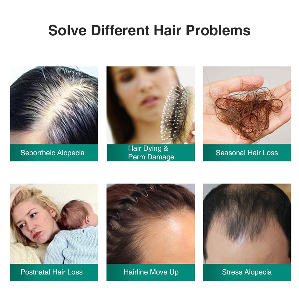Hair Growth Products Ginger Hair Spray Essential Oil Hair Loss For Men Women Hair Care Tools - adamshealthstore